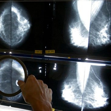 Some breast cancer patients can avoid certain surgeries, studies suggest