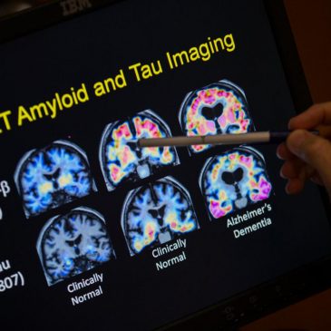 FDA OKs first blood test that can help diagnose Alzheimer’s disease