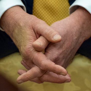 Trump is checked for swelling in legs and was diagnosed with a common condition in older adults