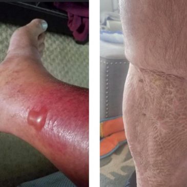 How to protect yourself from Vibrio vulnificus, the bacteria found in some coastal waters