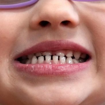 FDA restricts use of kids’ fluoride supplements citing emerging health risks