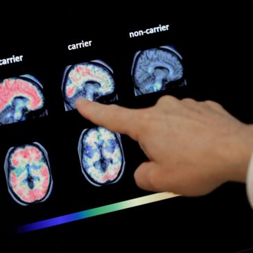 Boston University researchers say CTE is a cause of dementia